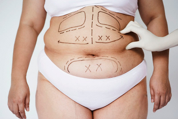 Abdominoplastia - Clínica Avril